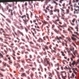 Melanoma, epithelioid Melanoma, epithelioid